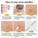 11pcs Acne Pimples Blackhead Remover Clip Facial Cleaner