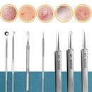 11pcs Acne Pimples Blackhead Remover Clip Facial Cleaner